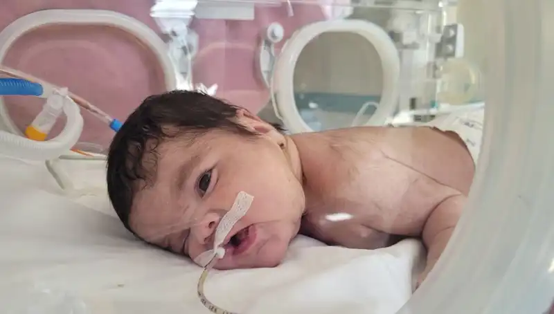 Dünyada Eşine Şahit Olunmayan 7'nci Vakada Eymen Bebek Hayata Tutundu