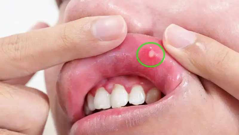 Vücudunuzdaki B Vitamini Eksikliğini Gösteren 5 Belirgin Belirti